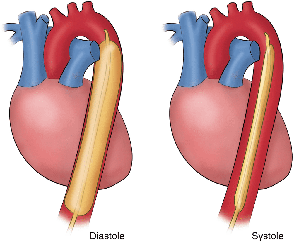 intra-aortic-balloon-pump-2182575